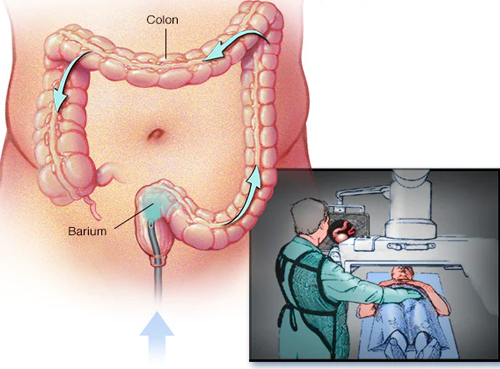 Barium Studies